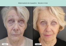 Blépharoplastie supérieure et inférieure, résultat AV/AP à 4 mois