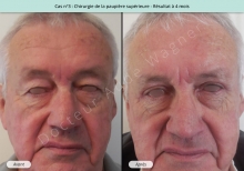 Blépharoplastie supérieure, résultat à 4 mois