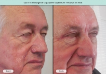 Blépharoplastie supérieure, résultat à 4 mois