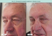 Blépharoplastie supérieure, résultat à 4 mois