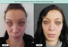 Traitement des cernes par injection d'acide hyaluronique à Toulouse