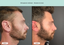 Cas n°2 résultat rhinoplastie médicale à 6 mois de profil droit