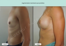 Cas n°4 résultat augmentation mammaire par prothèse de profil gauche