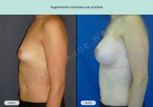 Cas n°7 résultat augmentation mammaire par prothèse de  profil gauche