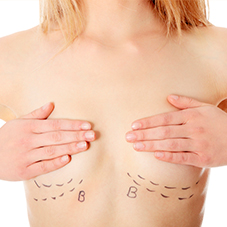 Augmentation mammaire. Prothèses ou réinjection de graisse à Toulouse