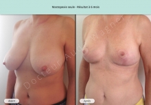 Cas n°3 résultat à 6 mois mastopexie seule de face  de trois-quarts gauche
