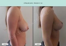 Cas n°5 résultat lifting des seins à 1 an de profil droit