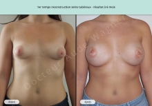 Cas n°1 de résultat reconstruction mammaire de seins tubéreux à 6 mois de face