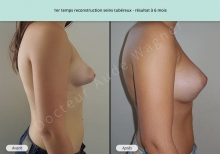 Cas n°1 résultat de reconstruction mammaire de seins tubéreux à 6 mois de profil droit
