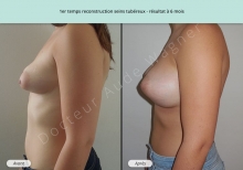 Cas n°1 résultat de reconstruction mammaire de seins tubéreux à 6 mois de profil gauche