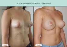 Cas n°1 résultat de reconstruction mammaire de seins tubéreux à 6 mois de face de trois-quarts droit