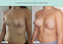 Cas n°1 résultat de reconstruction mammaire de seins tubéreux à 6 mois de face de trois-quarts gauche