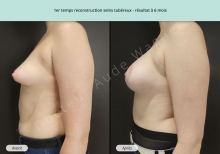Cas n°2 résultat de reconstruction mammaire de seins tubéreux à 6 mois de profil gauche