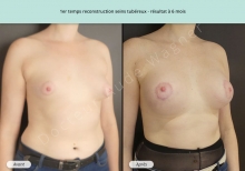 Cas n°2 résultat de reconstruction mammaire de seins tubéreux à 6 mois de face de trois-quarts droit