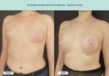 Cas n°2 résultat de reconstruction mammaire de seins tubéreux à 6 mois de face de trois-quarts gauche