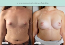 Cas n°3 résultat de reconstruction mammaire de seins tubéreux à 1 an de face