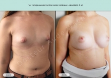 Cas n°3 résultat de reconstruction mammaire de seins tubéreux à 1 an de face de trois-quarts droit