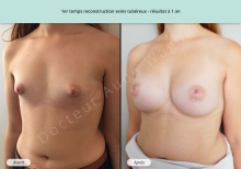 Cas n°3 résultat de reconstruction mammaire de seins tubéreux à 1 an de face de trois-quarts gauche