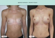 Cas n°4 résultat de reconstruction pour agnésie mammaire à 15 jours de face