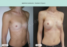 Cas n°4 résultat de reconstruction pour agnésie mammaire à 15 jours de face de trois-quarts droit