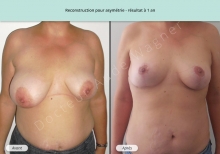 Cas n°5 résultat de reconstruction mammaire pour asymétrie à 1 an de face