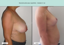 Cas n°5 résultat de reconstruction mammaire pour asymétrie à 1 an de profil droit