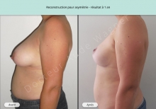 Cas n°5 résultat de reconstruction mammaire pour asymétrie à 1 an de profil gauche