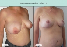Cas n°5 résultat de reconstruction mammaire pour asymétrie à 1 an de face de trois-quarts droit