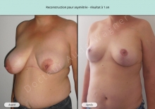 Cas n°5 résultat de reconstruction mammaire pour asymétrie à 1 an de face de trois-quarts gauche