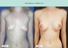 Cas n°6 résultat de reconstruction mammaire de seins tubéreux à 1 an de face