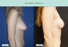Cas n°6 résultat de reconstruction mammaire de seins tubéreux à 1 an de profil droit