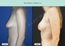 Cas n°6 résultat de reconstruction mammaire de seins tubéreux à 1 an de profil gauche