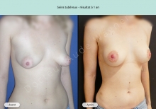 Cas n°6 résultat de reconstruction mammaire de seins tubéreux à 1 an de face de trois-quarts droit