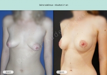 Cas n°6 résultat de reconstruction mammaire de seins tubéreux à 1 an de face de trois-quarts gauche
