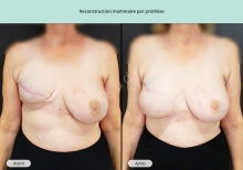 Cas n°6 résultat de reconstruction mammaire par prothèse de face