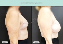 Cas n°6 résultat de reconstruction mammaire par prothèse de profil droit