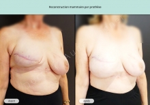 Cas n°6 résultat de reconstruction mammaire par prothèse de face de trois-quarts droit
