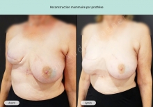 Cas n°6 résultat de reconstruction mammaire par prothèse de face de trois-quarts gauche