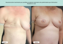Cas n°7 résultat AV AP de reconstruction des seins par prothèse à Toulouse