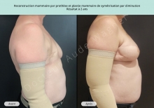  Cas n°7 résultat AV AP de reconstruction mammaire par prothèse à Toulouse