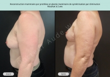 Cas n°7 résultat avant après de reconstruction mammaire par prothèse à Toulouse