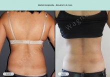 Cas n°2 résultat d'abdominoplastie de dos