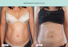 Cas n°2 résultat d'abdominoplastie de face