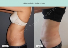 Cas n°2 résultat d'abdominoplastie de profil gauche