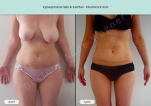 Cas n°4 résultat de lipoaspiration de la taille et des hanches de face