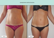 Cas n°5 résultat de lipoaspiration de la taille et des hanches de face