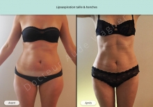 Cas n°6 résultat de lipoaspiration de la taille et des hanches de face