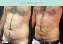 Cas n°7 liposuccion abdominale résultat à 6 mois de face trois quart gauche