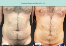 Cas n°7 liposuccion abdominale résultat à 6 mois de face