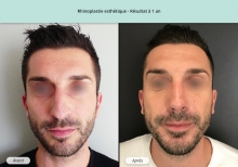 Cas n°11 résultat de rhinoplastie esthétique à un an de face